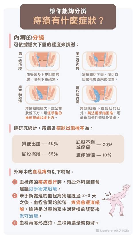 痔瘡坐墊大樹|有痔瘡問題看這一篇就夠了！醫師超完整解析：教你一。